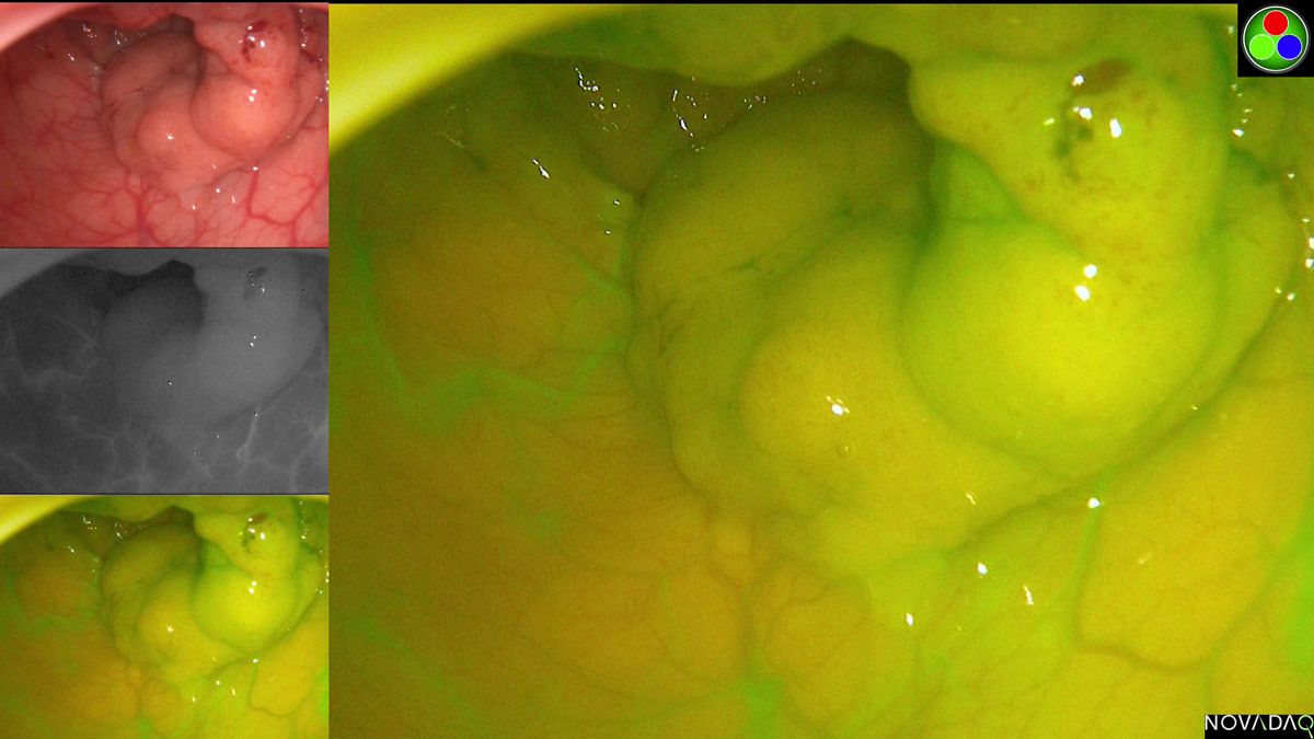 Four images of the same rectal tumor shown via endoscopy