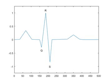 Abbildung 2: Ein QRS-Komplex eines EKG-Signals.
