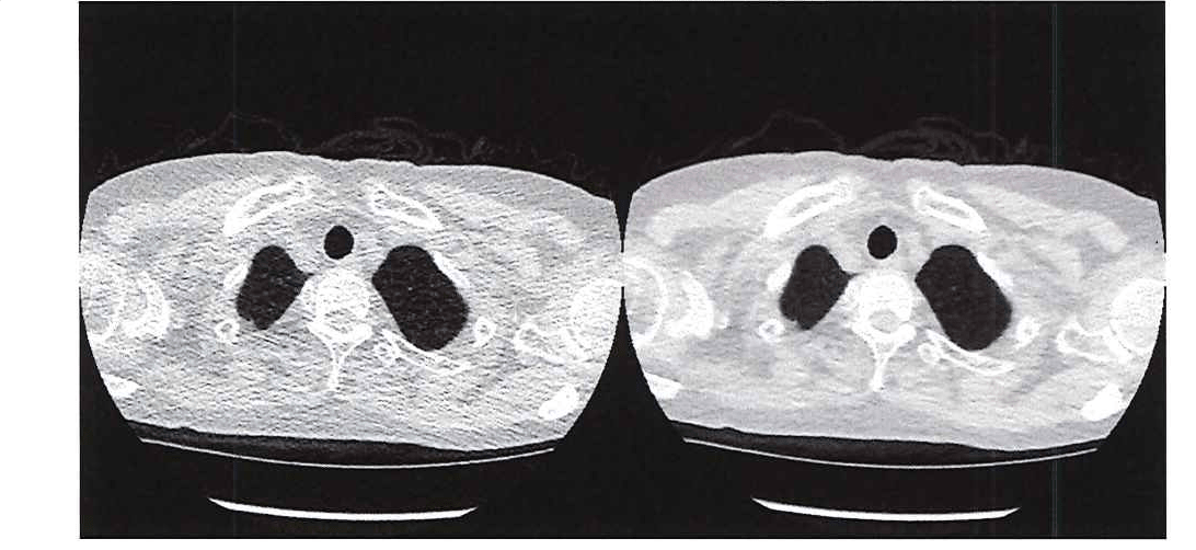 Abbildung 1: Vergleich der Bildqualität eines Ultraniedrigdosis-CTs (links) mit einem herkömmlichen CT (rechts).