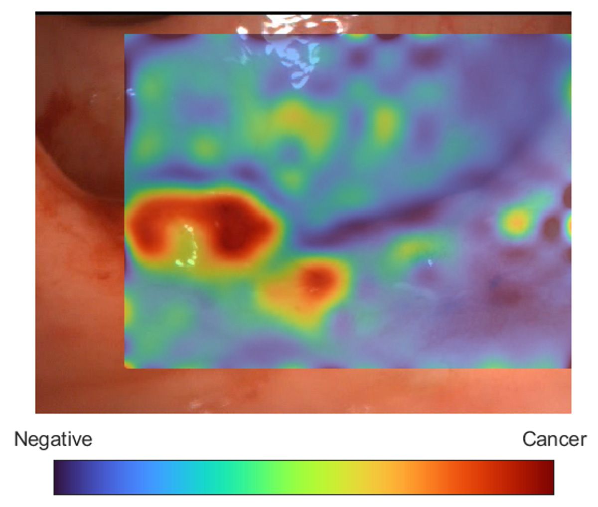 Ein Bild eines Dickdarmpolypen wird mit einer farbcodierten Überlagerung angezeigt, die die von der KI vorhergesagte Wahrscheinlichkeit angibt, ob eine Region krebsartig oder nicht krebsartig ist.