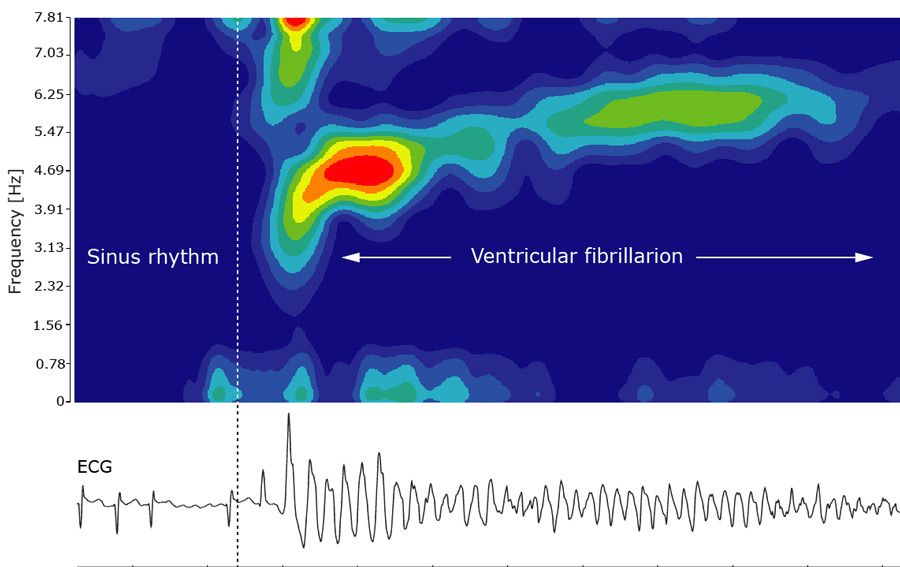 Predictive analytics was used to develop detection algorithms to reduce false alarms in ICUs.