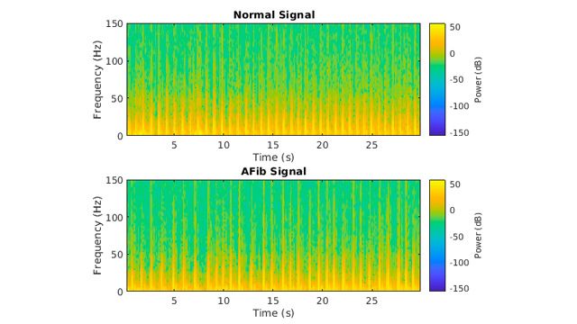 Klassifikation von EKG-Signalen mit LSTM-Netzen (Long Short-Term Memory)