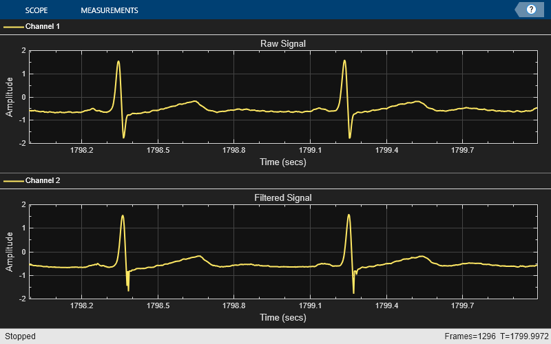 Outlier Removal Techniques with ECG Signals