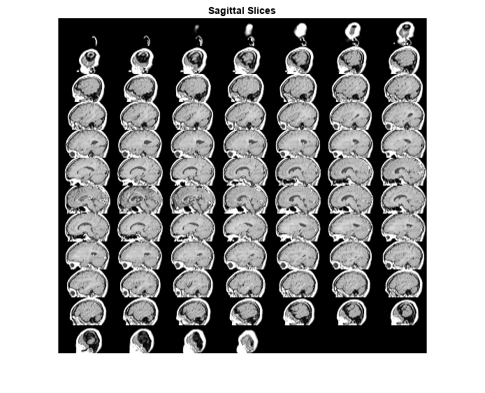 Figure contains an axes object. The axes object with title Sagittal Slices contains an object of type image.