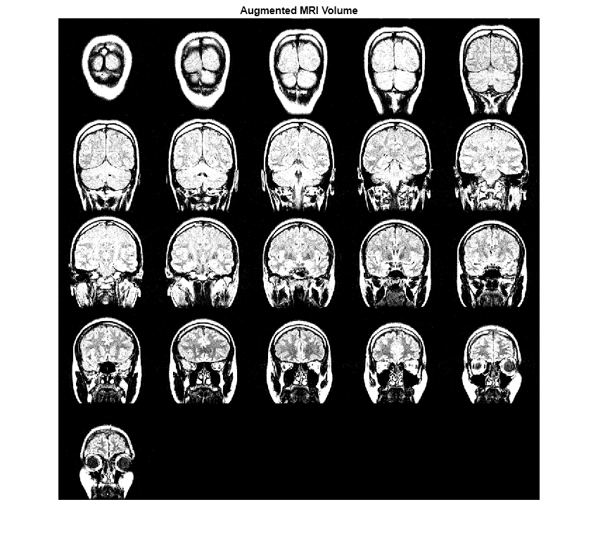 Figure contains an axes object. The hidden axes object with title Augmented MRI Volume contains an object of type image.